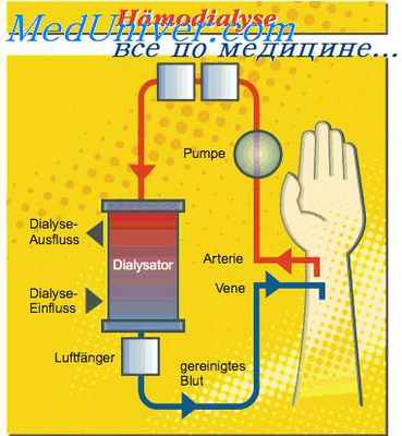 гемодиализ