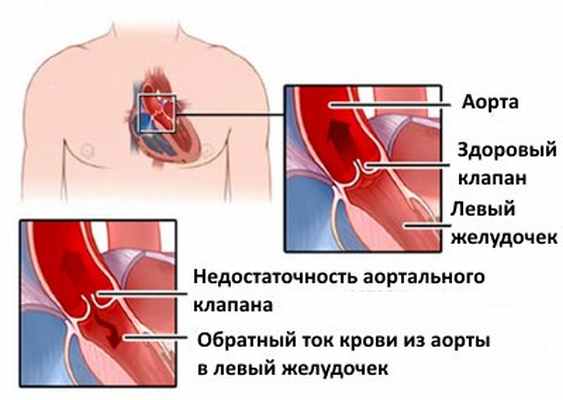 Недостаточность аортального клапана