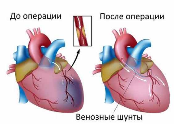 Аортокоронарное шунтирование