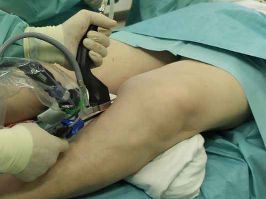 Этап эндоскопической подготовки венозного шунта с левого бедра