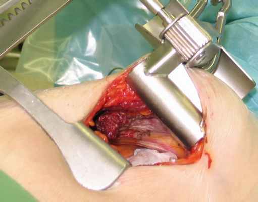 Выделение левой внутренней грудной артерии