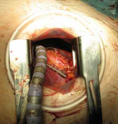 Сформированный анастомоз с ПМЖВ