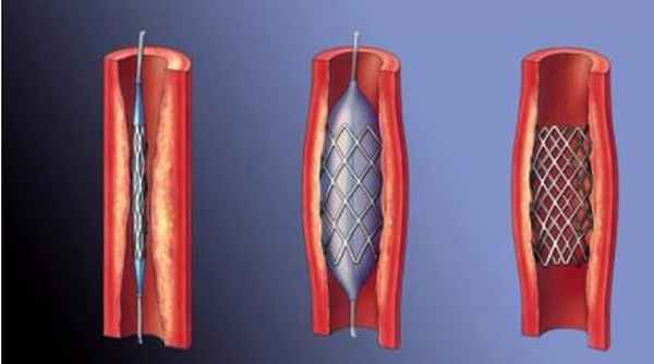Реваскуляризация миокарда - медицинский центр Инкор, Владикавказ