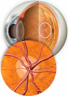 Лечение атрофия зрительного нерва