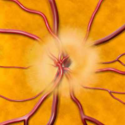 Лечение атрофия зрительного нерва