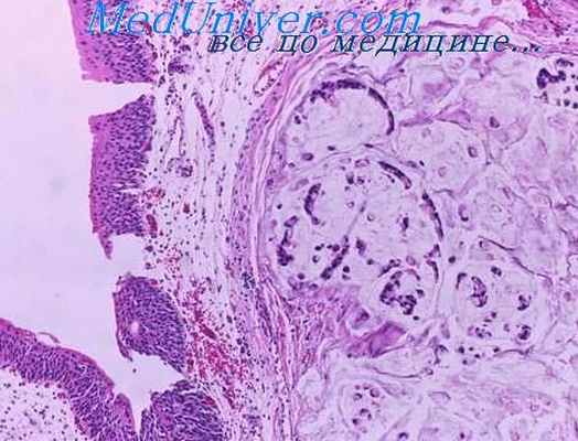 аденокарцинома