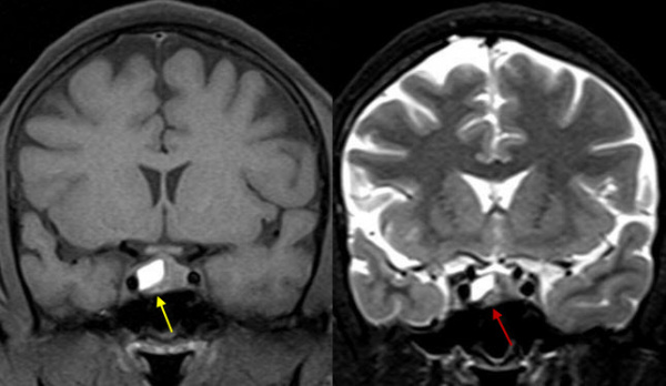 МРТ. Кровоизлияние в аденому гипфиза