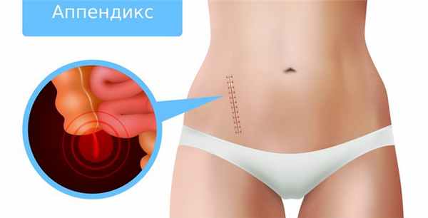 Аппендицит - симптомы и лечение