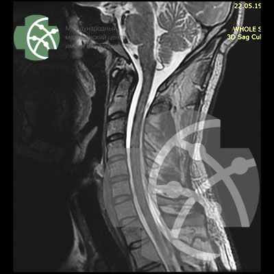 МРТ шейного отдела позвоночника