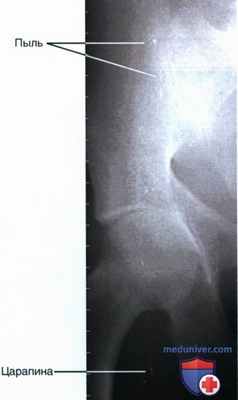 Артефакты на рентгенограмме