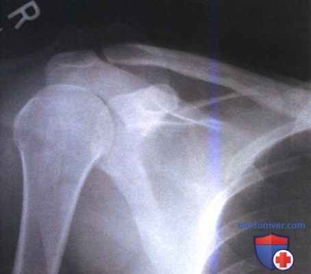 Артефакты на рентгенограмме