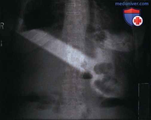 Артефакты на рентгенограмме