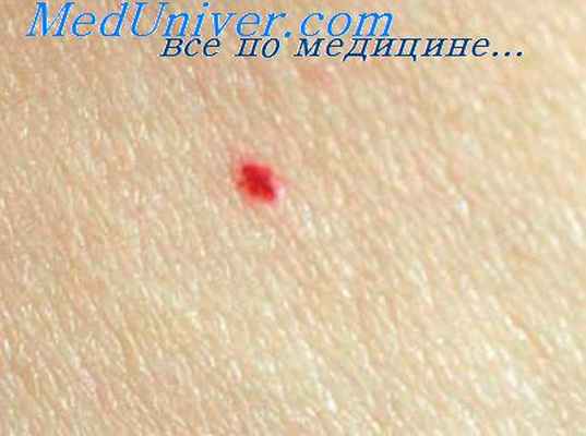 артериальная ангиома