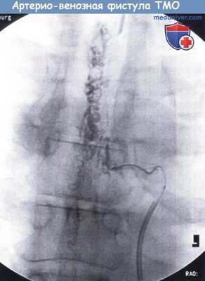Ангиография артерио-венозной фистулы твердой мозговой оболочки спинного мозга
