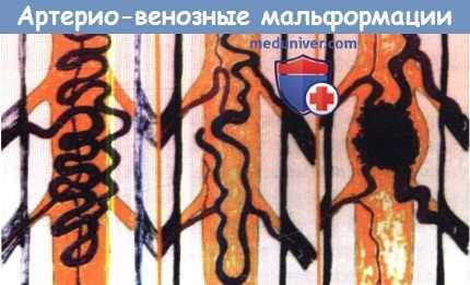 Артерио-венозные мальформации спинного мозга