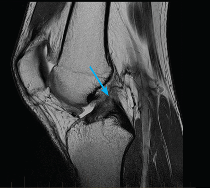 разрыв крестообразной связки