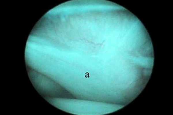 Медиальная суставно-плечевая связка