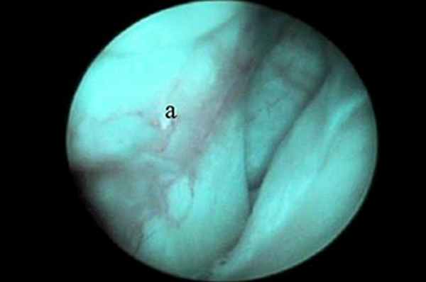 Место прикрепления сухожилия двуглавой мышцы