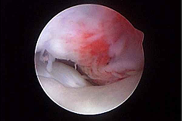 Тендосиновит в месте прикрепления сухожилия двуглавой мышцы