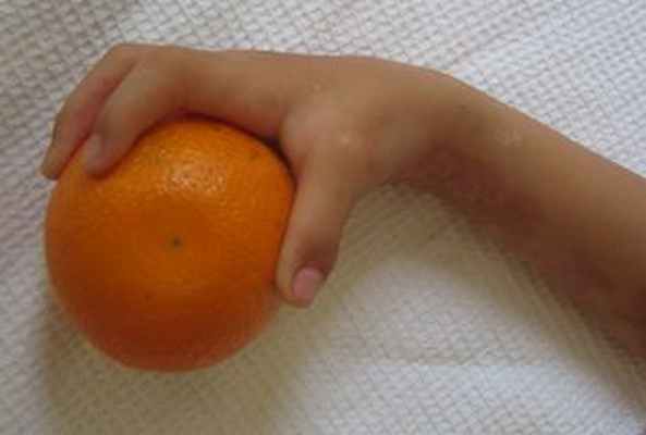 turner.ru артрогрипоз