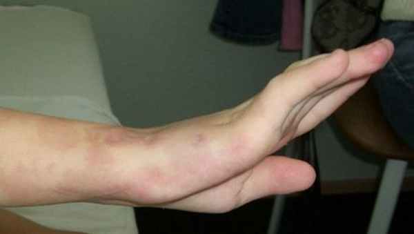 turner.ru артрогрипоз