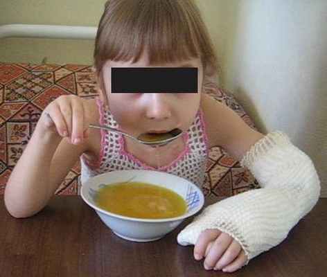 turner.ru артрогрипоз