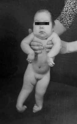 turner.ru артрогрипоз