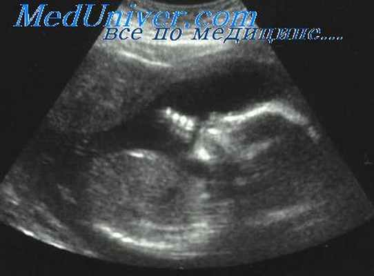 артрогриппоз у плода