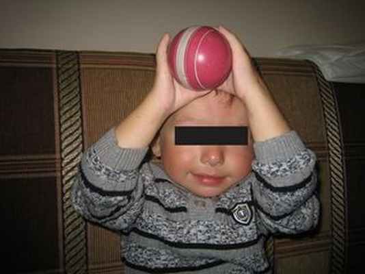 turner.ru артрогрипоз