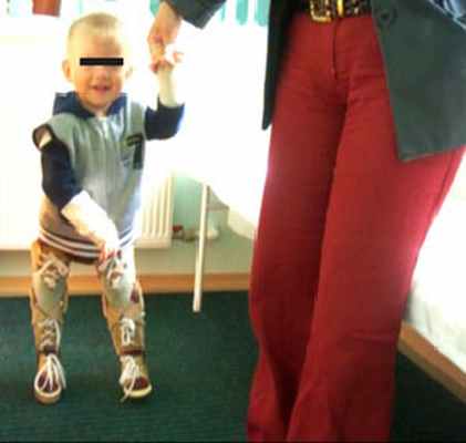 turner.ru артрогрипоз