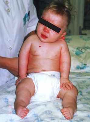 turner.ru артрогрипоз