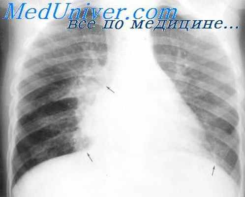 аспергиллема