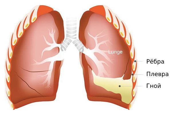 Эмпиема плевры