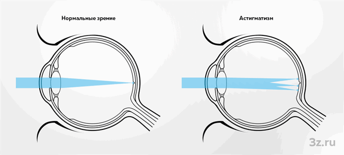 Астигматизм — 3Z