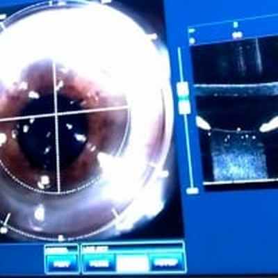 Операция при астигматизме глаза - Центра глазной хирургии по лечению глаз, коррекции и восстановлению зрения при помощи лазера.
