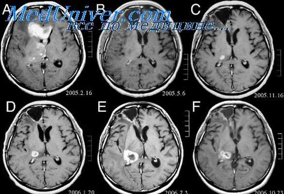 астроцитарные опухоли