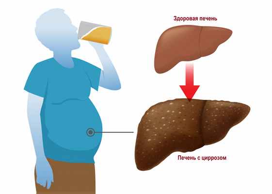 Цирроз печени.jpg