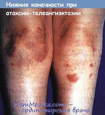 атаксия-телеангиэктазия