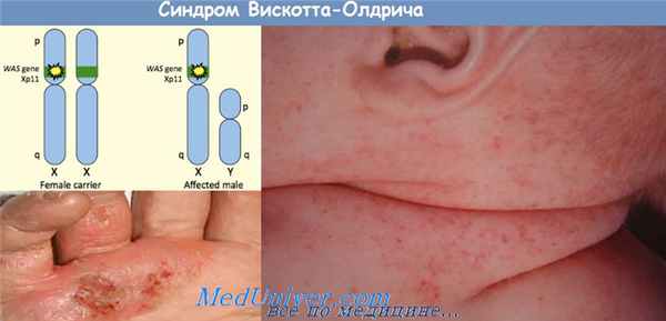синдром Вискотта-Олдрича