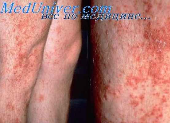 атебриновый дерматит