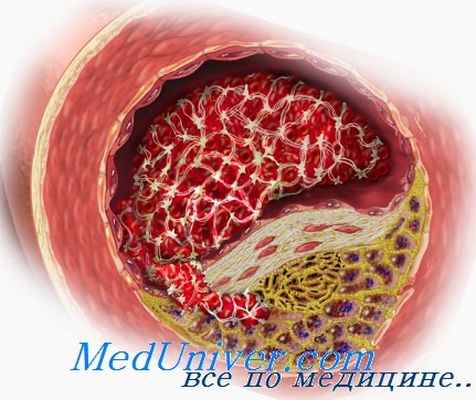 атеросклероз и андрогены