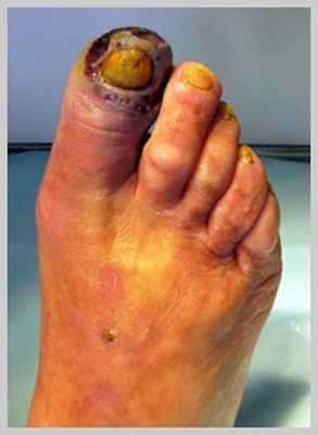 некроз большого пальца ноги