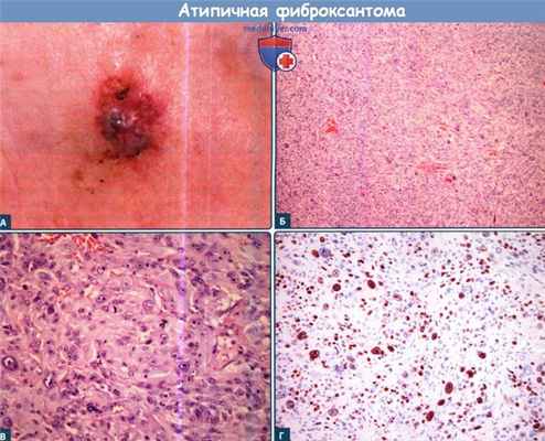 Атипичная фиброксантома (АФК)