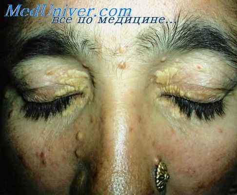 атипичная фиброксантома