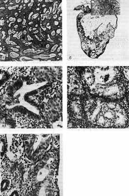 Гиперпластические процессы эндометрия