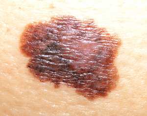 Меланома кожи: эпилюминесцентная дерматоскопия