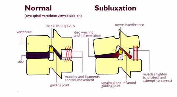 Здоровые позвонки и подвывих позвонка