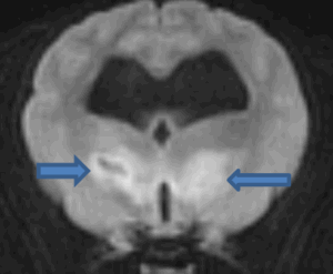 Read more about the article Эозинофильный менингоэнцефалит