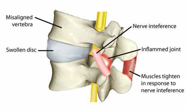 Раздражение нерва, воспаление, напряжение мышц