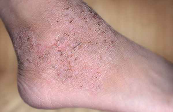 Дерматит у взрослых на ногах